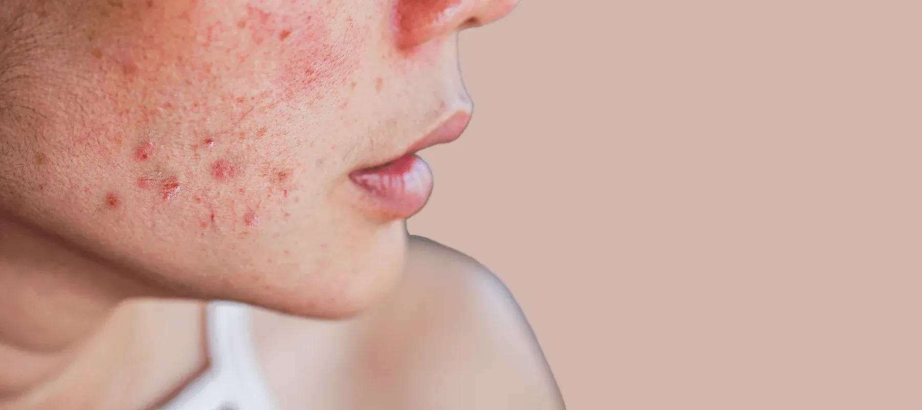 Know_the_causes_of_uneven_skin_tone-min_31a7536a-41de-4328-9a17-85ec1f891cb2.png.webp