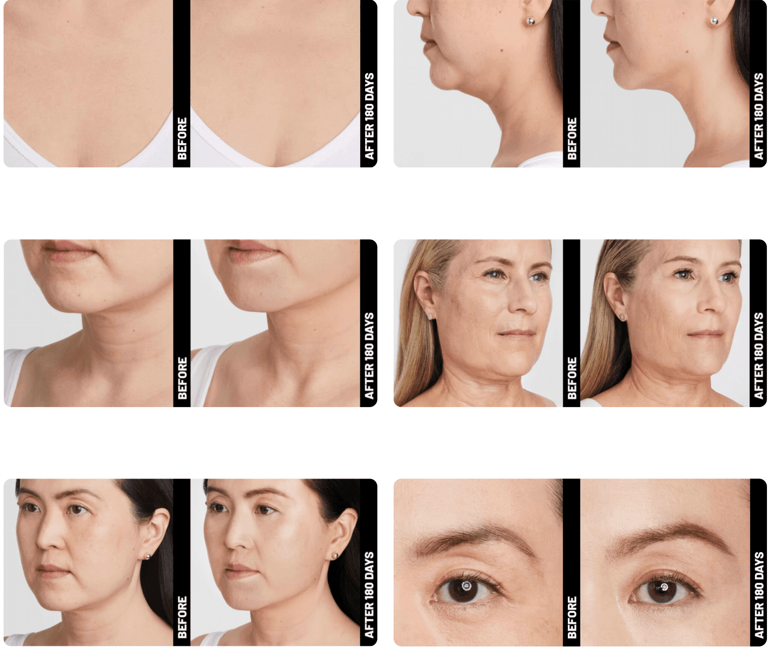 Ultherapy 2.png