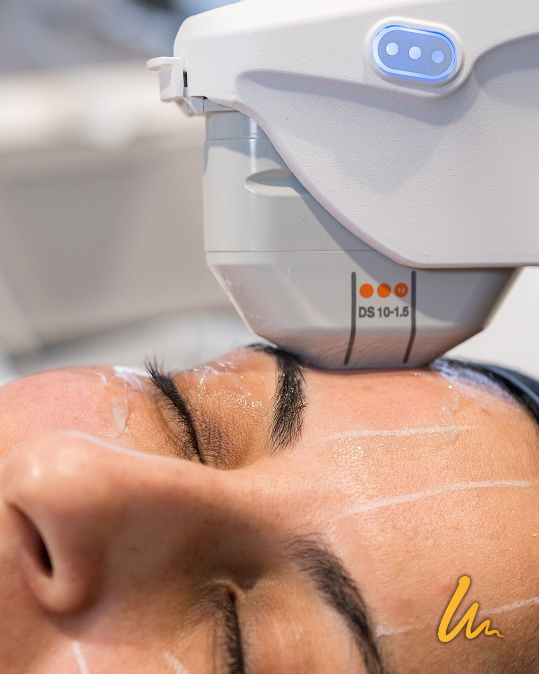 Ultherapy 2.jpg
