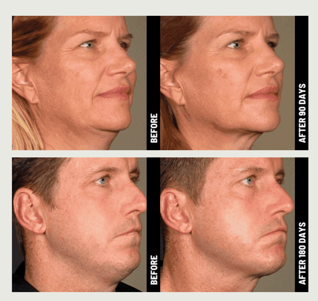 Ultherapy_Prime_1.png