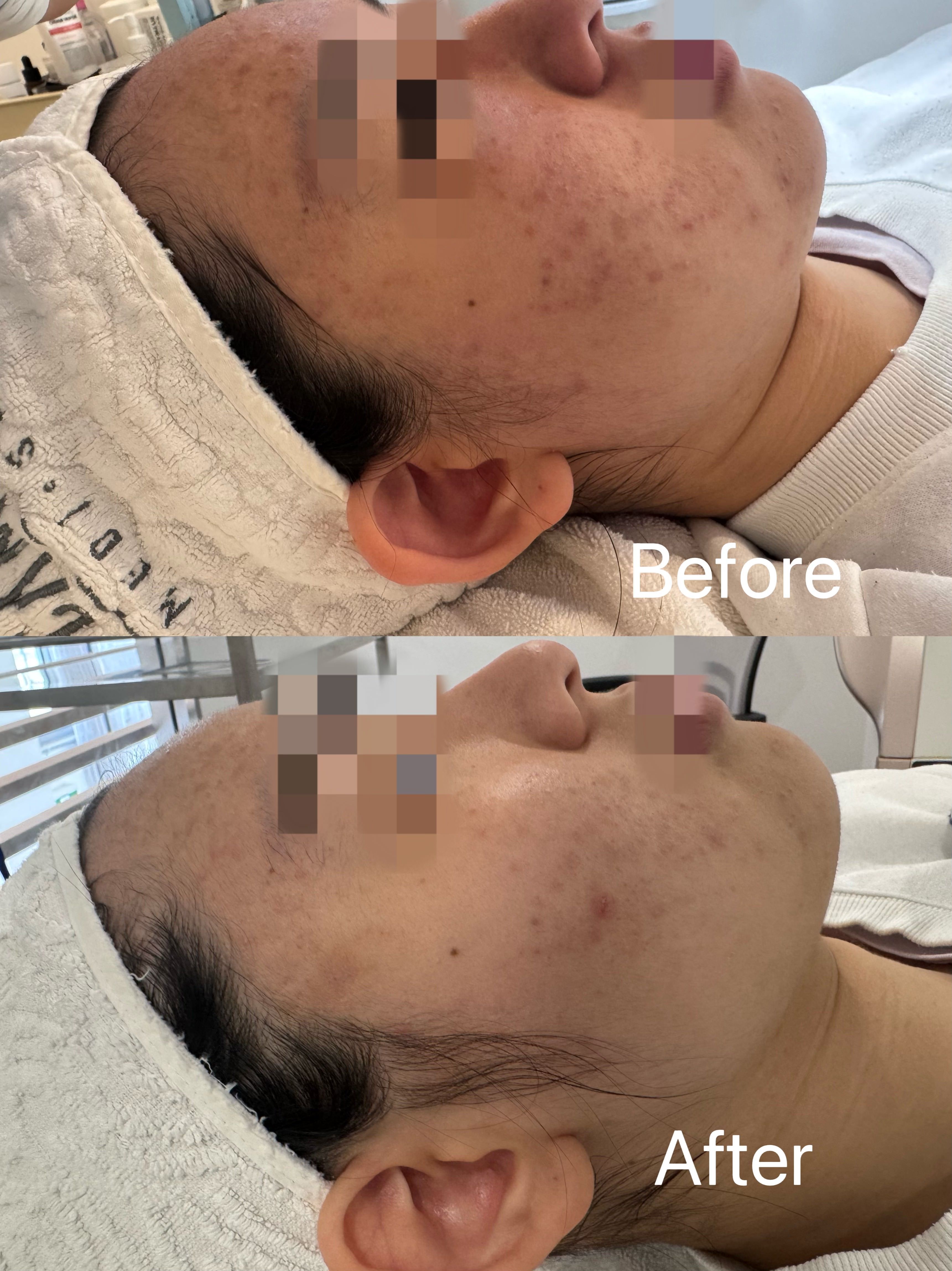 microneedling-before-after-canberra.jpg