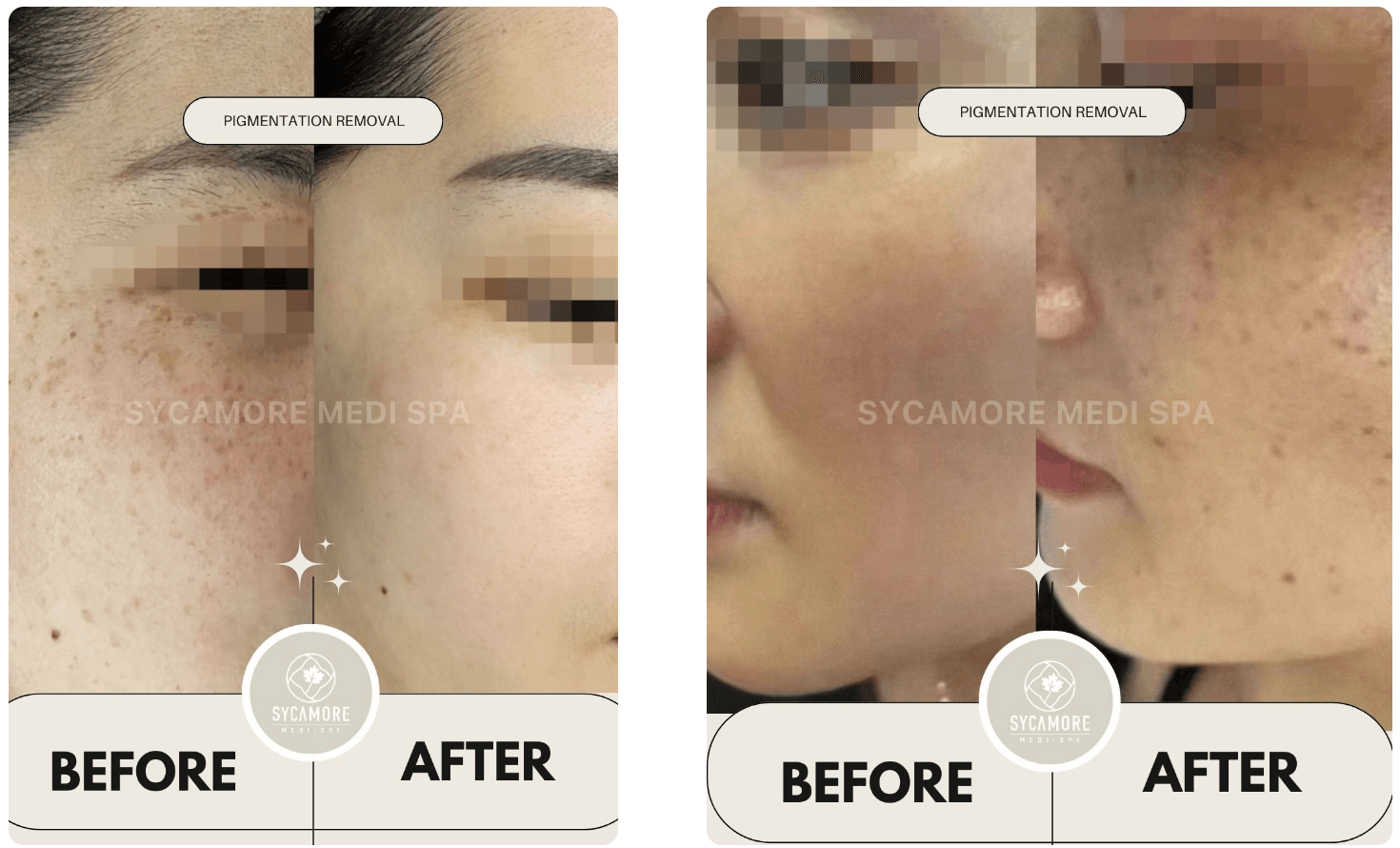 pigmentation-laser-before-after.png