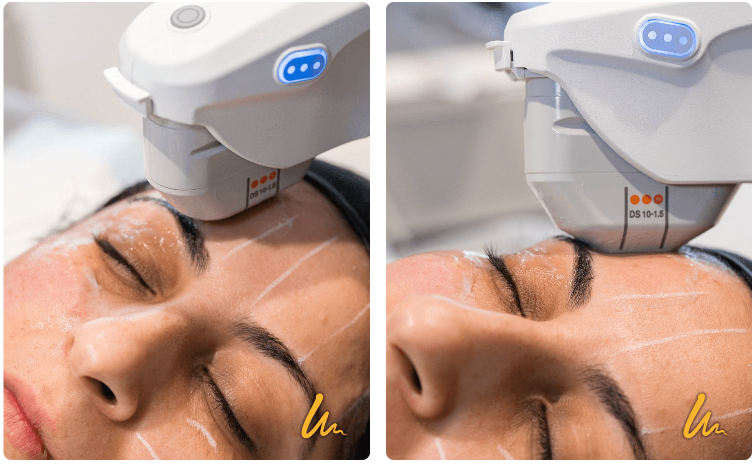 ultherapy 3.png